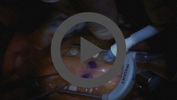 cabg
